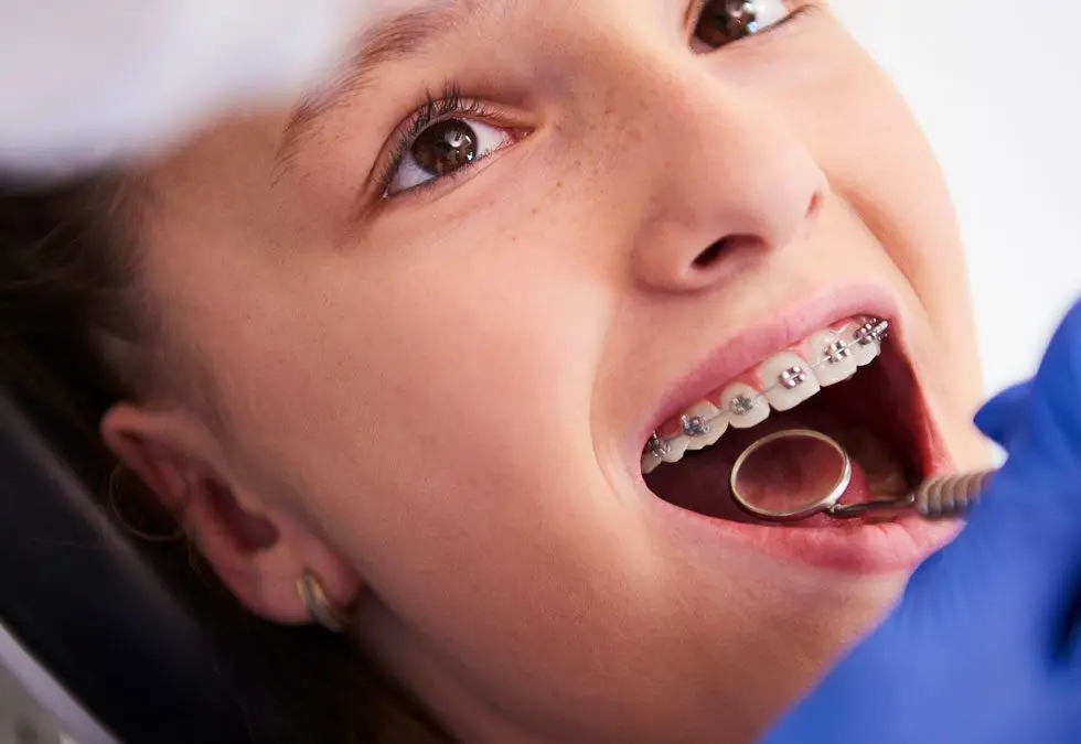 What to Expect After Getting Your Braces On