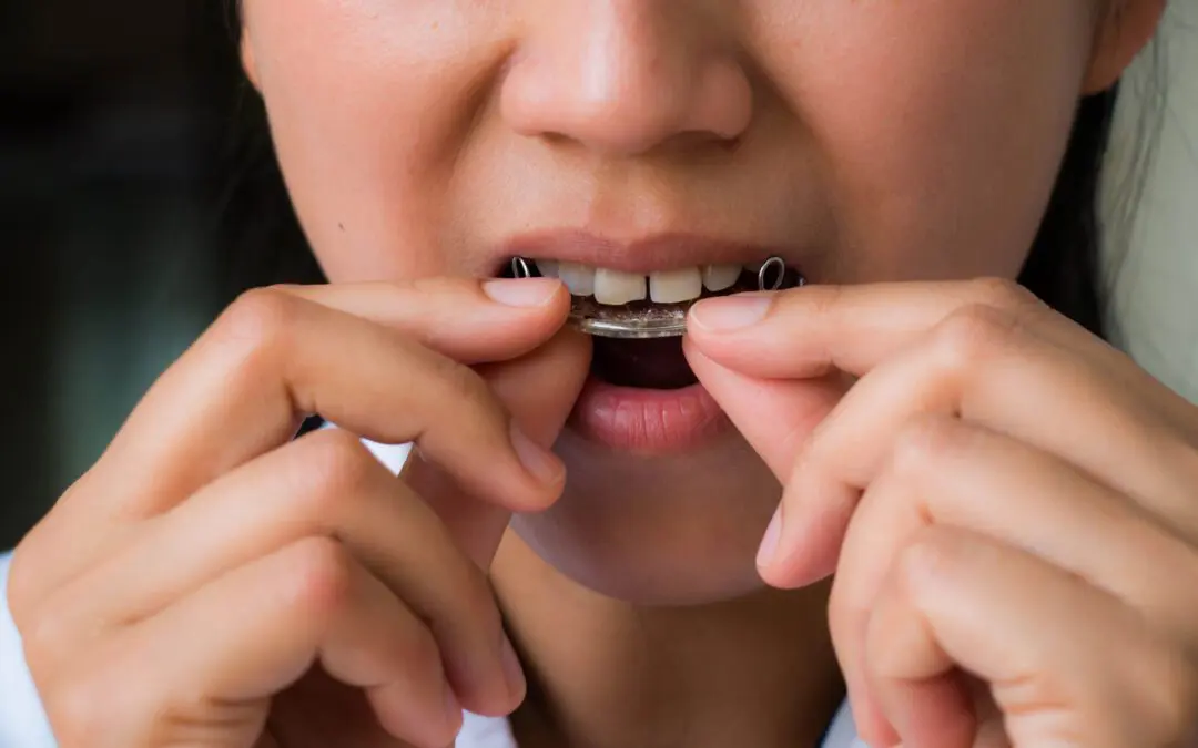 The Importance of Wearing Your Retainers 