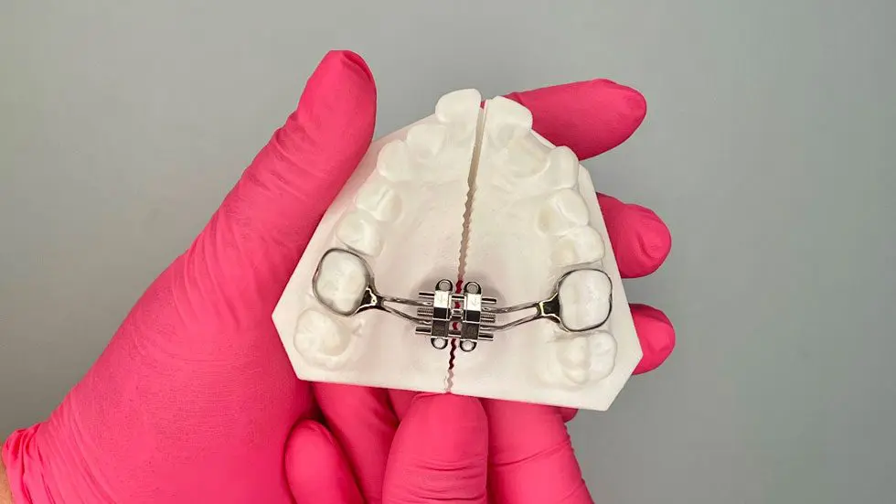 Maxillary Skeletal Expander on a set of fake teeth
