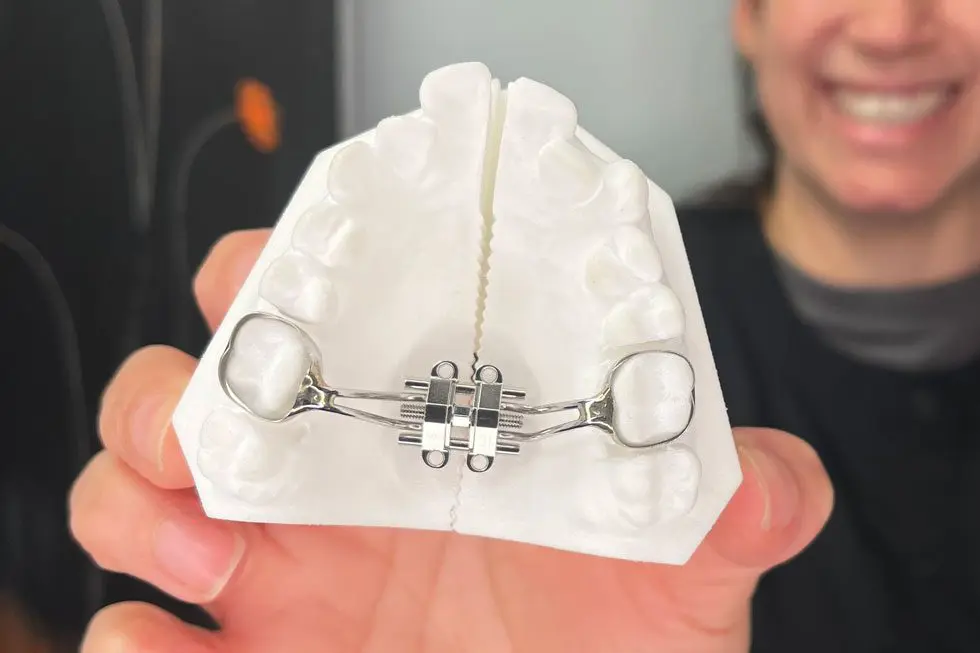 Maxillary Skeletal Expander on a set of plastic teeth