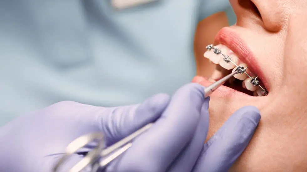 Make regular check ups with your orthodontist to check your braces