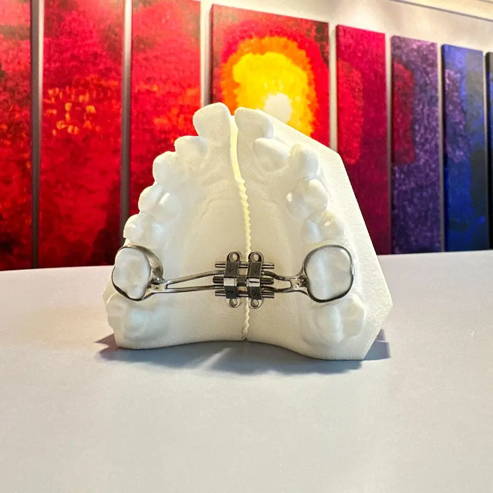 Maxillary skeletal expander appliance used in orthodontic treatment