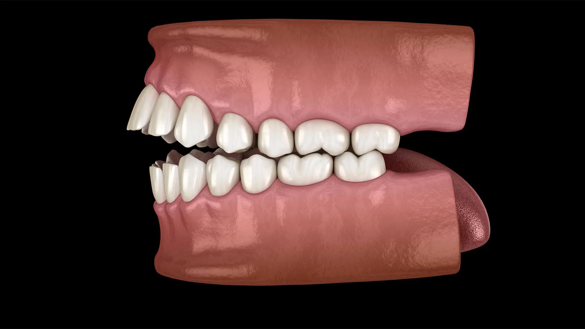 Malocclusion and bite misalignment linked to TMJ pain Daia