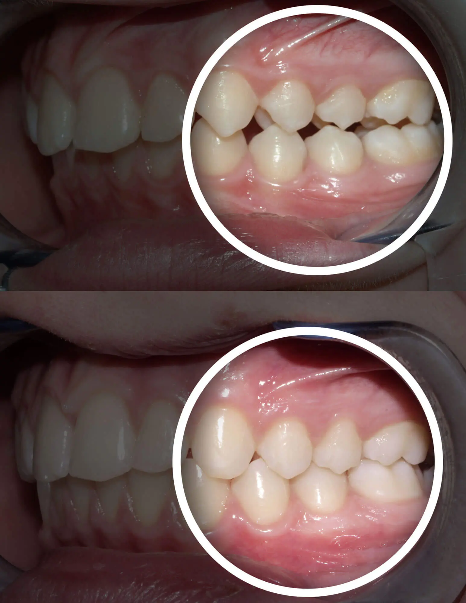 TMJ joint stress caused by improper bite alignment