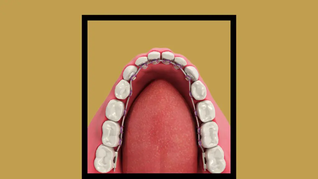 A 3D model of lingual braces.