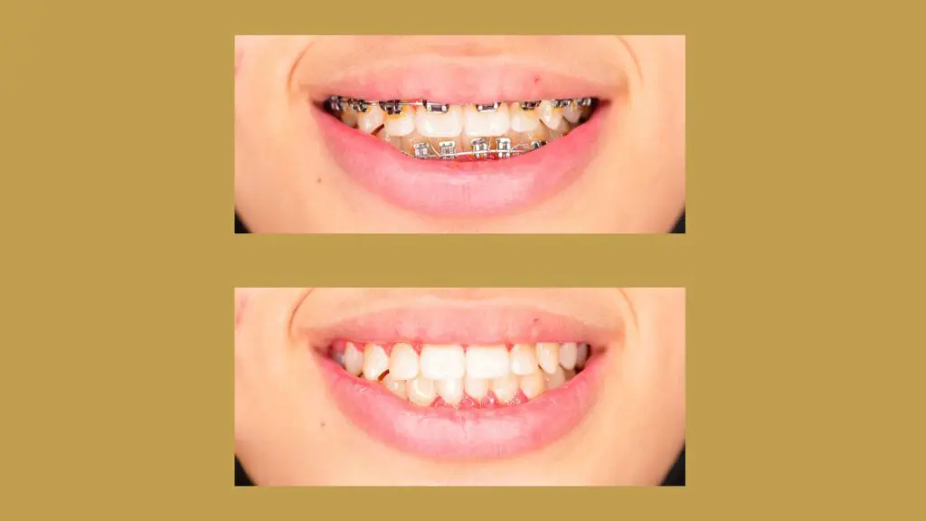 Before and after image of a patient with traditional braces from the top Michigan Orthodontics.