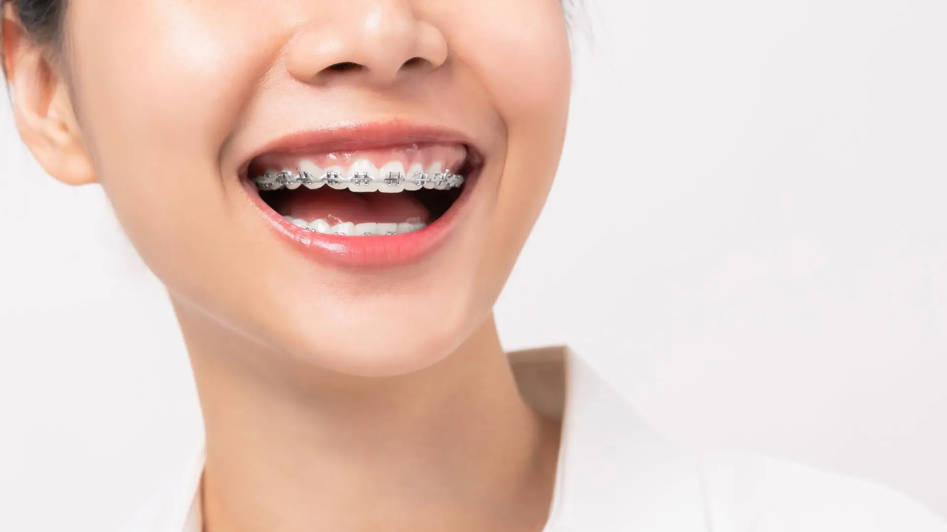 Indirect bonding technique used in orthodontic treatment