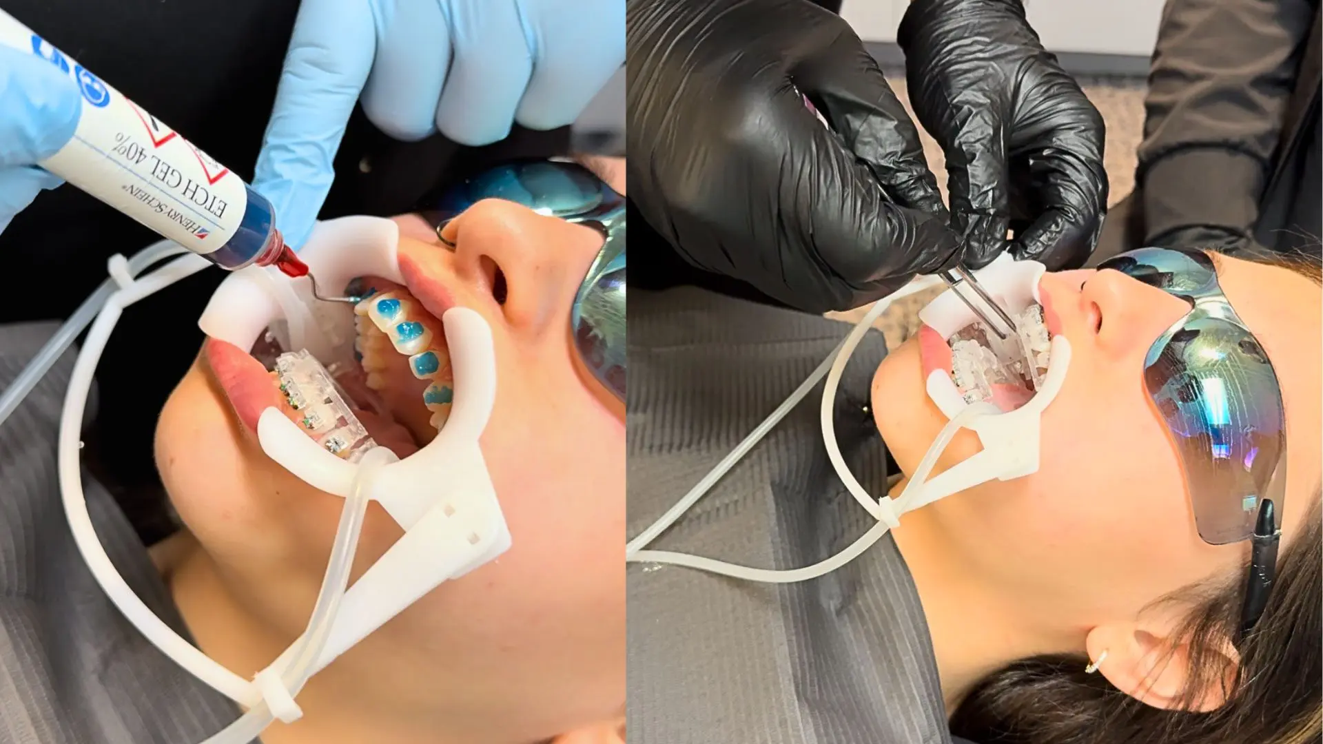 Daia Orthodontist using indirect bonding for braces placement