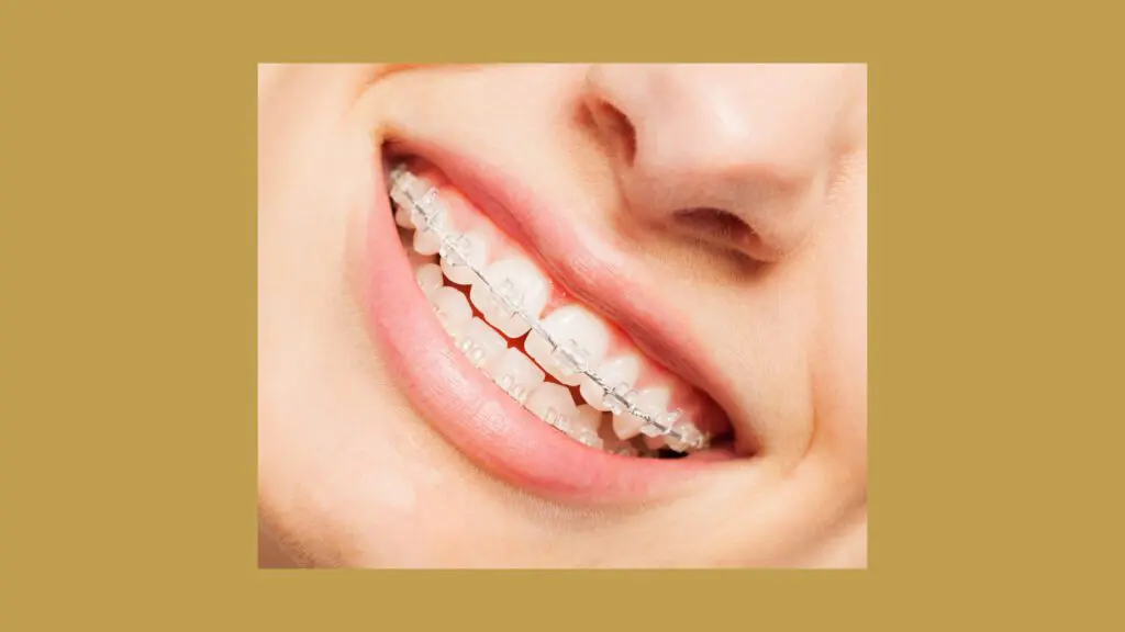 A woman smiling with clear ceramic braces.
