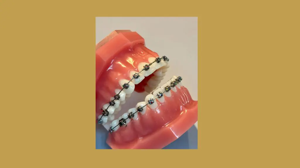 An example of self-ligating brackets, braces in Rochester.