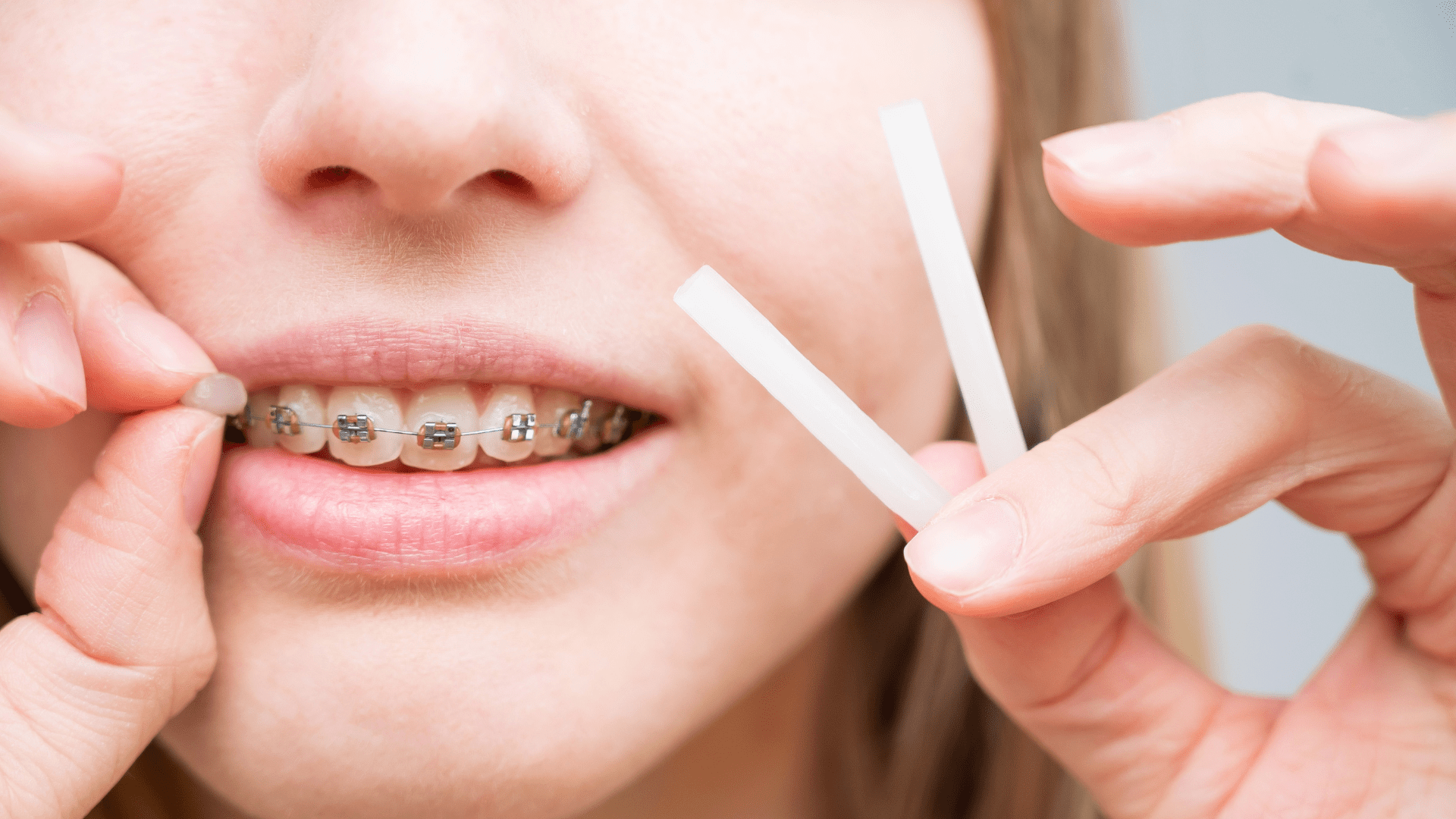 A person wearing traditional braces using wax provided by the best Rochester orthodontist, Dr. Daia