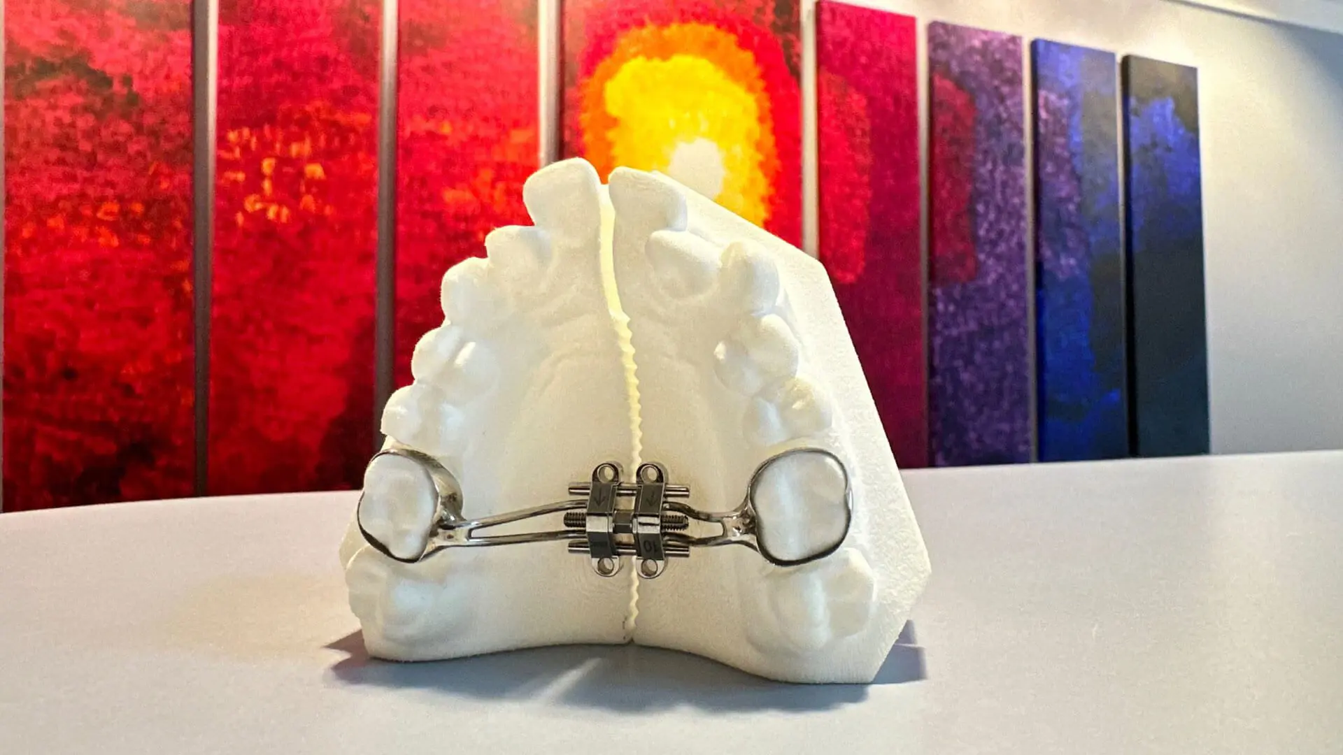 : A white model of teeth with metal expander