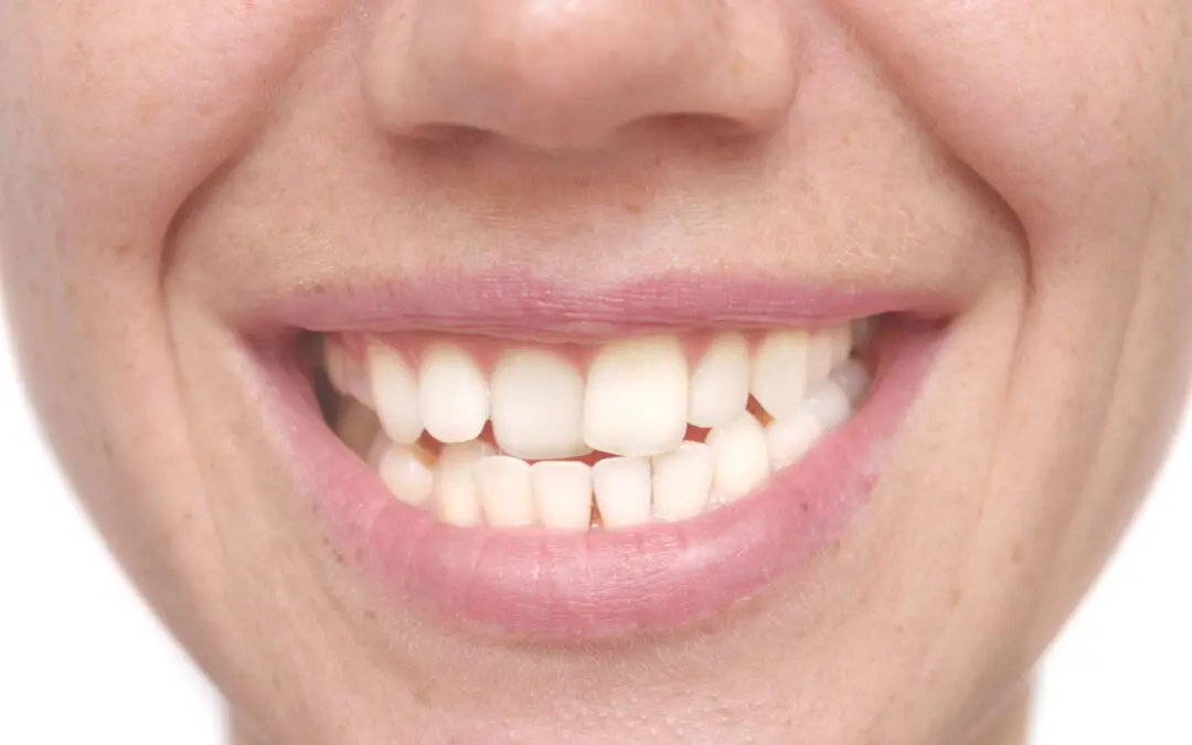 Why Are My Teeth Shifting? Understanding the Common Causes
