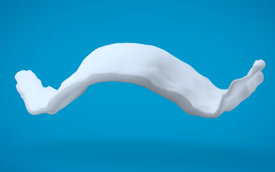 How 3D Printing Expanders is Revolutionizing Custom Treatment