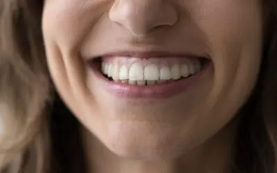 Correcting Gummy Smiles with Temporary Anchorage Devices (TADs): A Modern Approach to a Balanced Smile