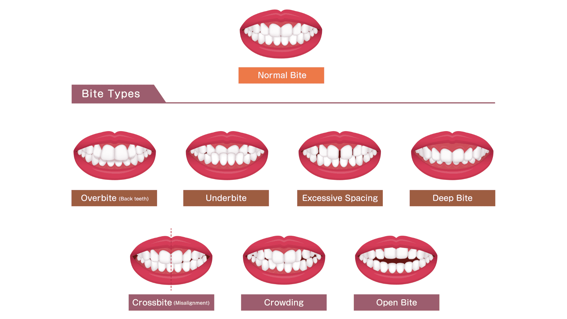 Diagram illustrating various bite types with labeled mouth illustrations. It includes normal bite at top, followed by overbite, underbite, excessive spacing, deep bite, crossbite, crowding, and