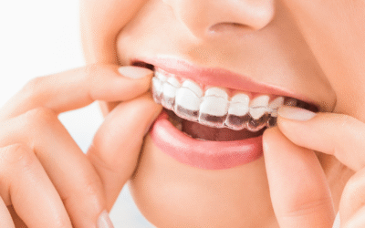 The Most Common Clear Aligner Mistakes and How to Avoid Them