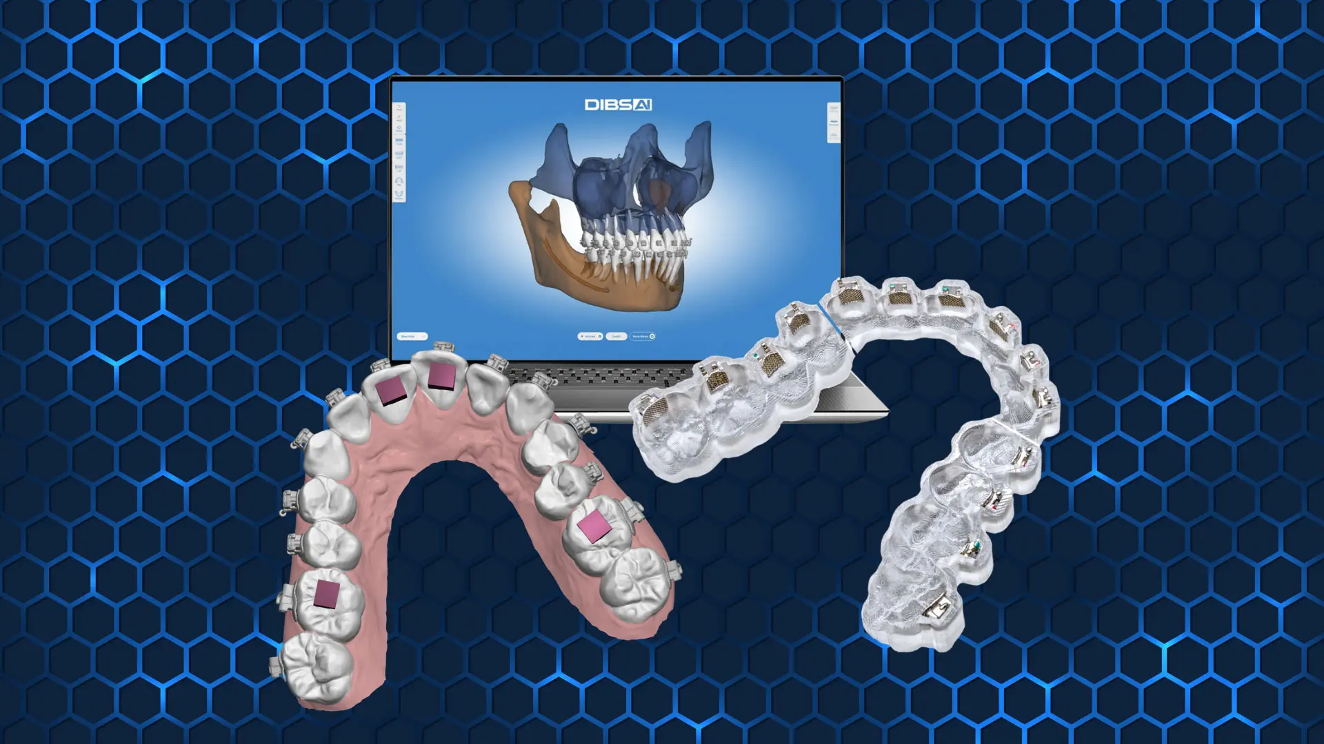 DIBS AI 3D dental modeling visualization showing upper and lower jaw structures with teeth and dental implants. Laptop screen displays a detailed 3D jaw model, while two dental arches with embedded implants and attachments are positioned in front, highlighting digital dental planning and implant placement