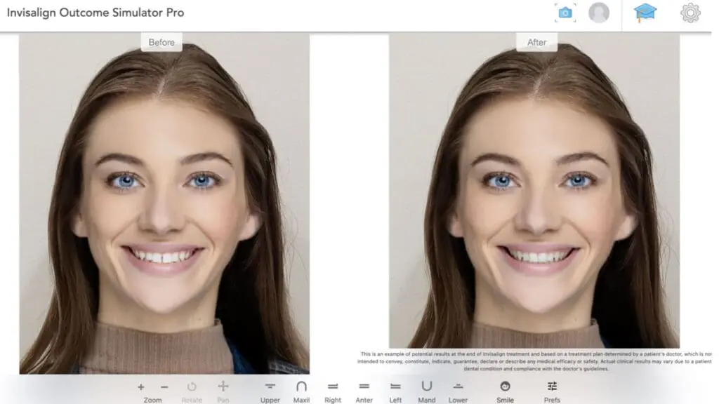Before-and-after photograph comparison from Invisalign Outcome Simulator Pro showing dental alignment changes after Invisalign treatment