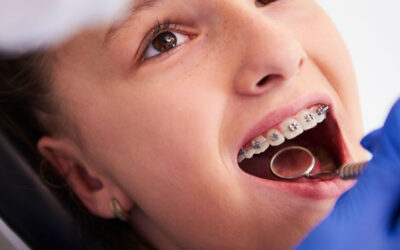What to Expect After Getting Your Braces On
