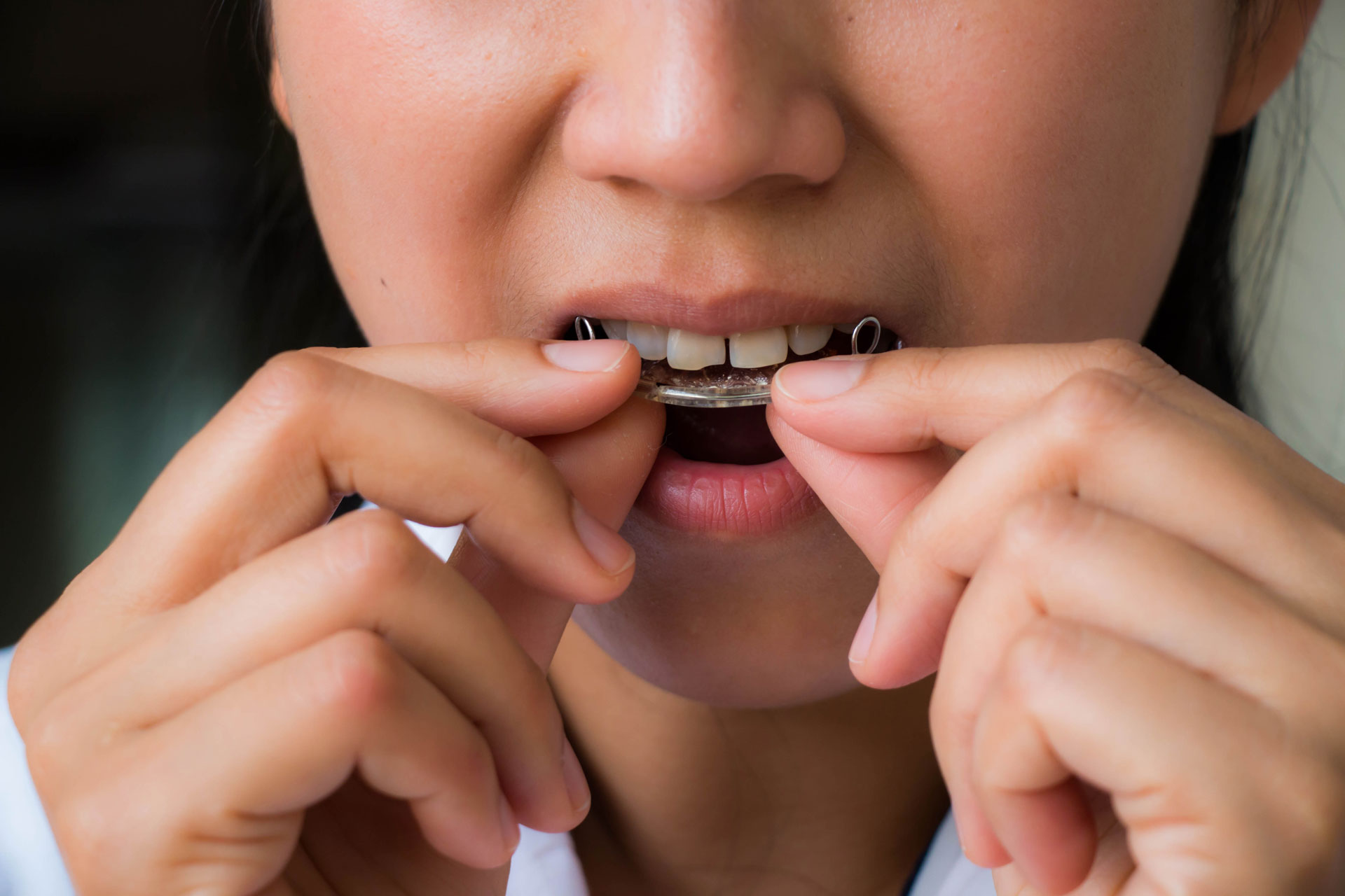 Girl putting retainer in mouth