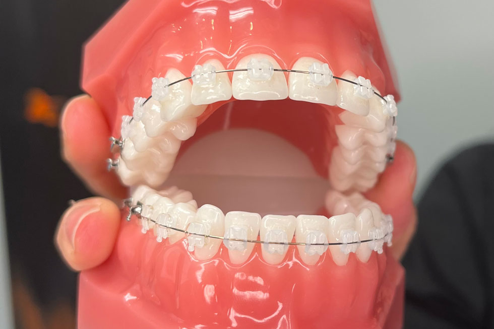 Ceramic braces on plastic set of teeth