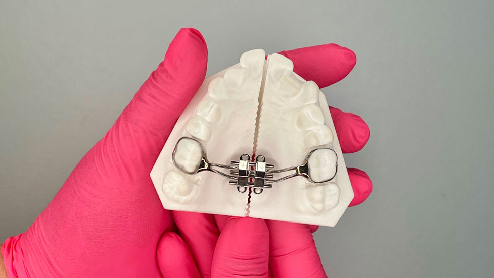 Maxillary Skeletal Expander on a set of fake teeth