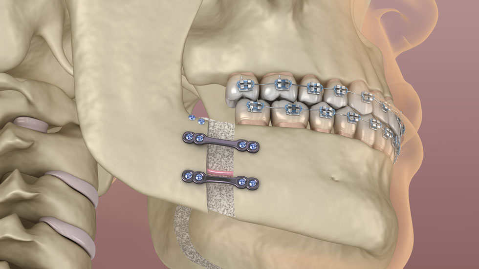 3D model of what corrective jaw surgery entales