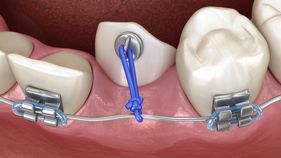 3D model of a row of teeth with an impacted tooth