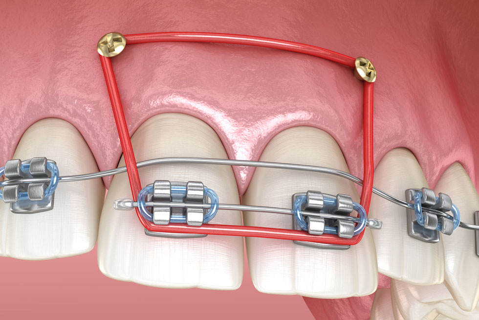 3D model of two teeth with a temporary anchorage device
