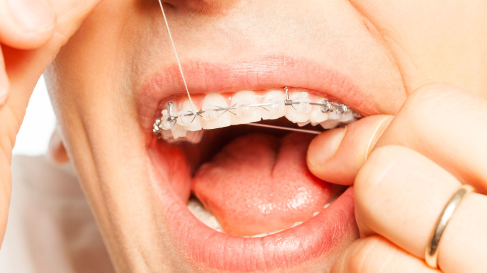 Maintain new braces by flossing