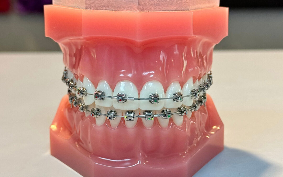 The Next Generation of Orthodontics: The Power of the Damon Ultima Bracket System