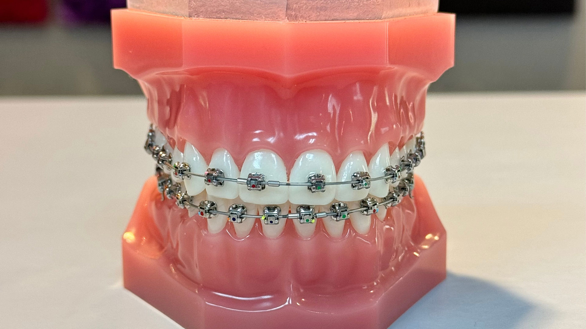A close-up of a model of teeth with braces