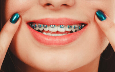 The Ultimate Guide to Braces and Clear Aligners