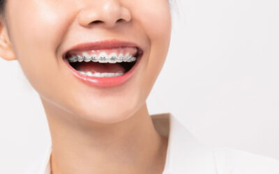 Indirect Bonding: The Future of Orthodontic Treatment