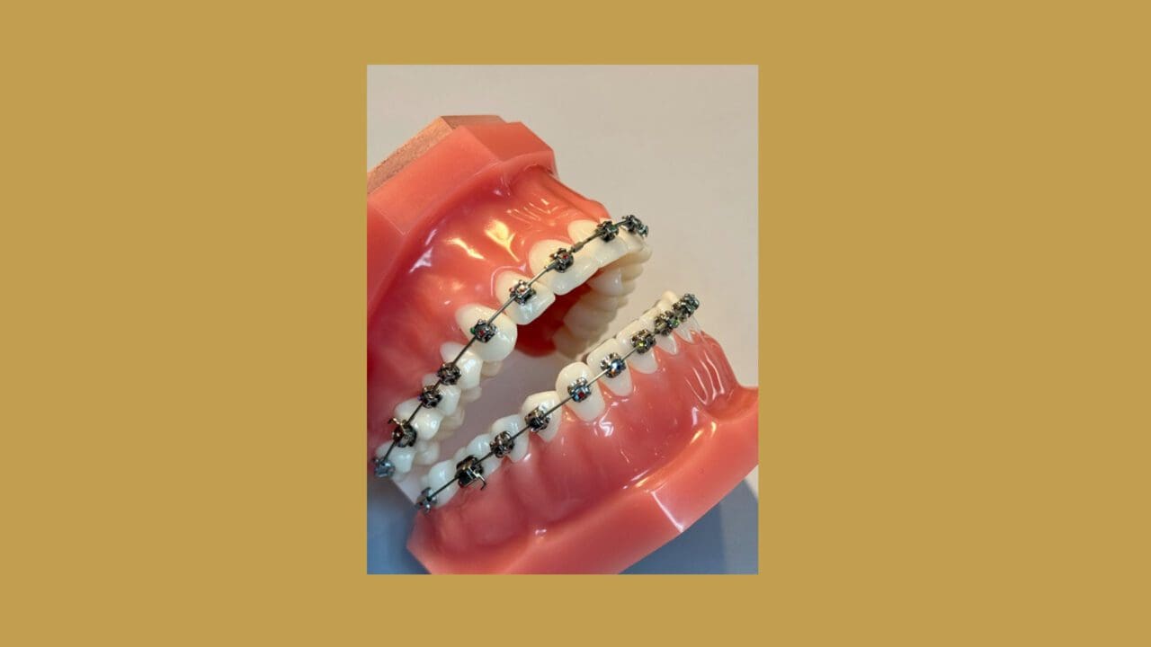 The Ultimate Guide to Braces and Clear Aligners