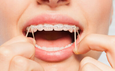 The Do’s and Don’ts of Wearing Rubber Bands with Braces