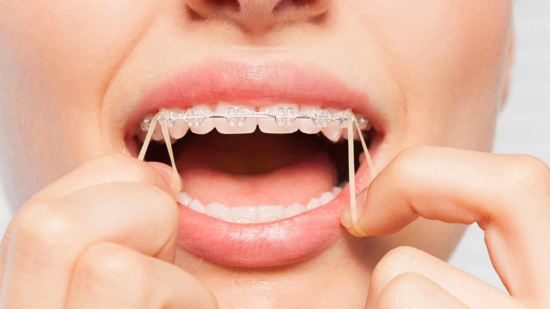 A person inserting rubber bands onto braces, a comprehensive orthodontic treatment from Dr. Daia